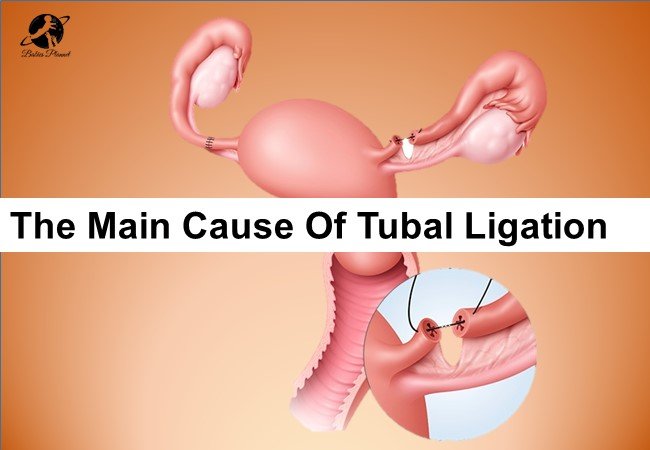 My tubes are tied but my period is late