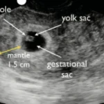 No Fetal Pole at 7 Weeks – Success Stories: Is There Still Any Hope?
