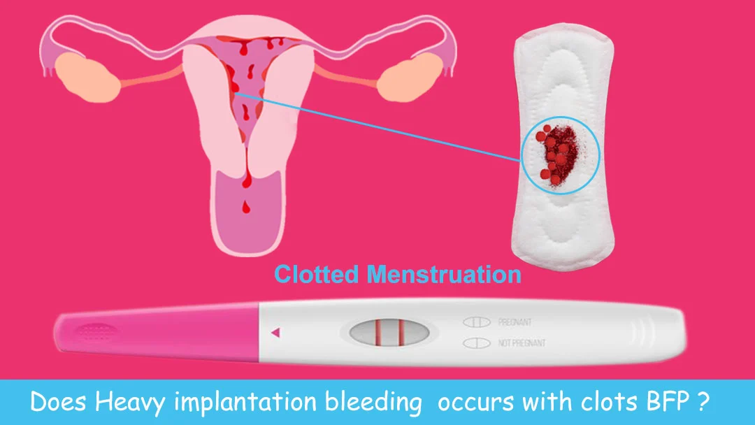 heavy-implantation-bleeding-with-clots-stories-with-pictures