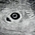 5w5d ultrasound picture