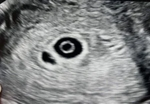 5w5d ultrasound picture of twin pregnant mother