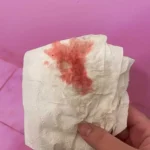 real pictures of heavy implantation bleeding