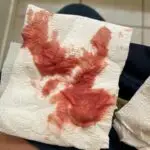 heavy implantation bleeding pictures
