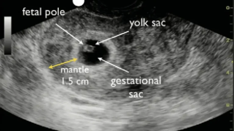 No fetal pole at 6 weeks should I be worried