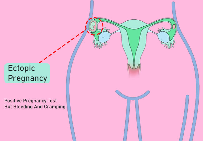 positive pregnancy test but bleeding and cramping