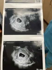 empty gestational sac at 7 weeks ultrasound picture