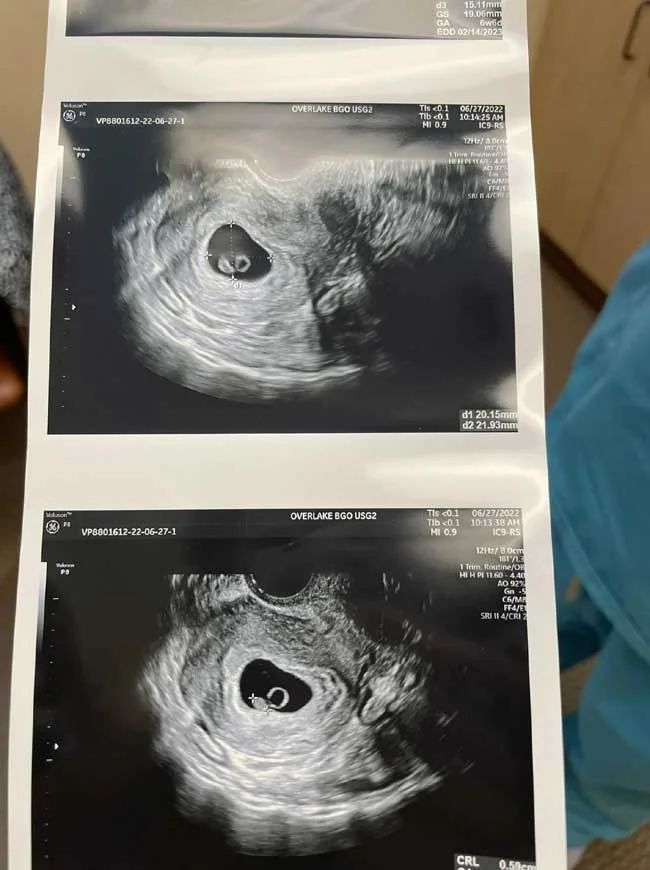 No Fetal Pole At 6 Weeks Should I Be Worried?