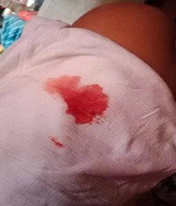 Bright red implantation bleeding pictures
