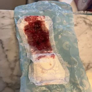 implantation bleeding pics on pad that is filled up