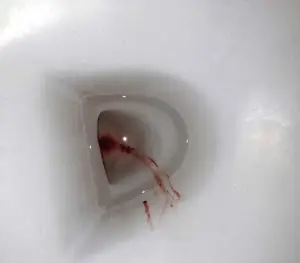 implantation bleeding pics on toilet