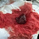 Heavy implantation bleeding with twins