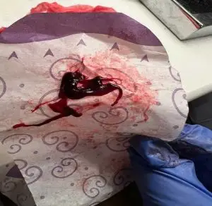 heavy implantation bleeding with clotting picture