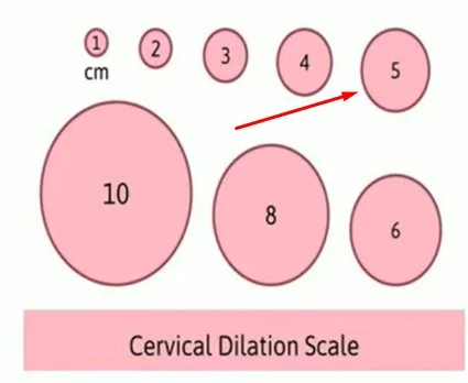 5Cm Dilated No Contractions