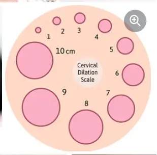 5 Cm Dilated picture