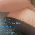 How to Keep C-Section Incision Dry When Overweight?