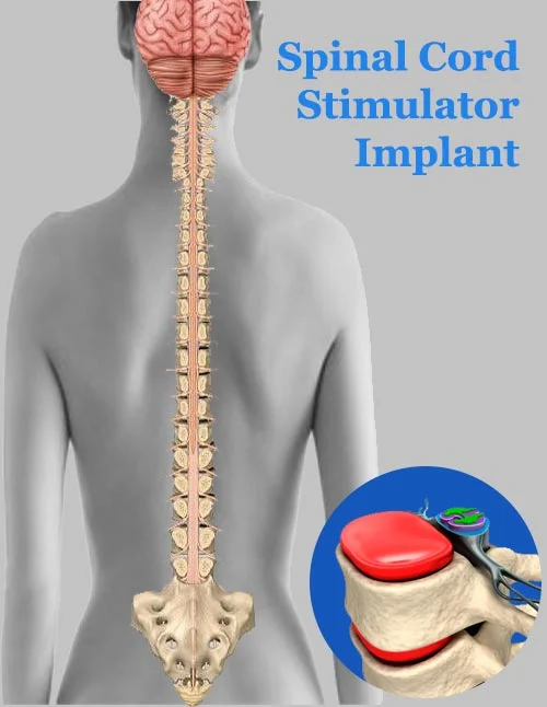 How painful is a spinal cord stimulator implant