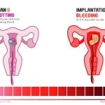 Plan B Spotting vs Implantation Bleeding