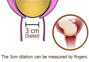 what does 3cm dilated look like