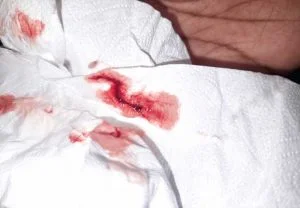 bright red picture implantation bleeding twins